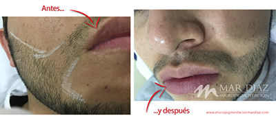 Tricopigmentación barba antes y después